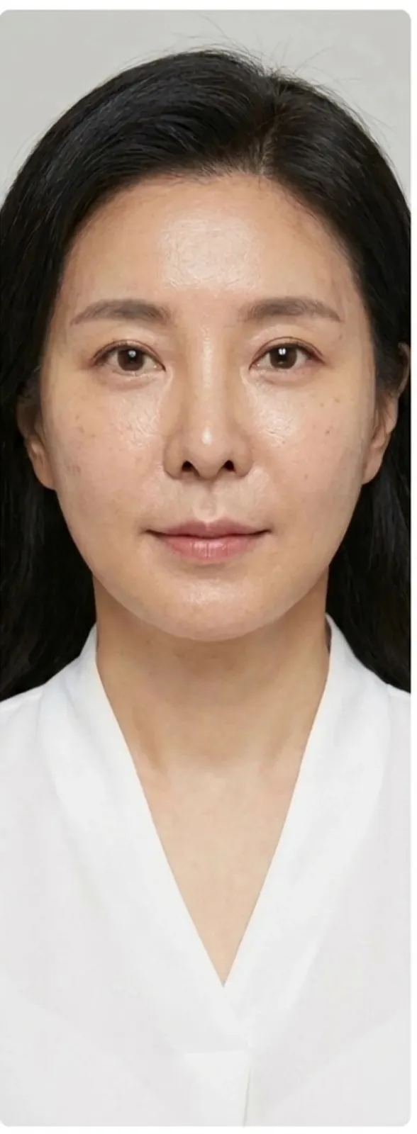 안면 리프팅 — 후