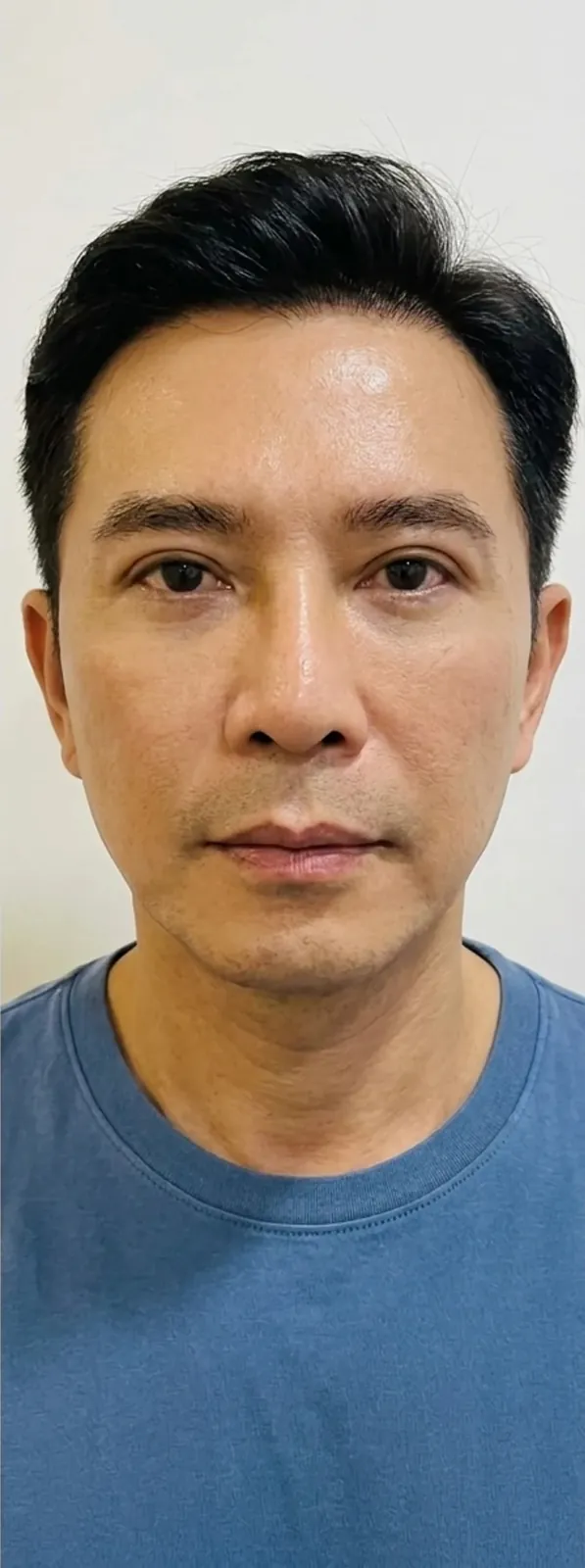 안면 리프팅 — 후