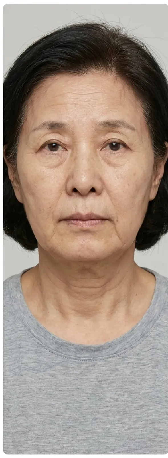 안면 리프팅 — 전