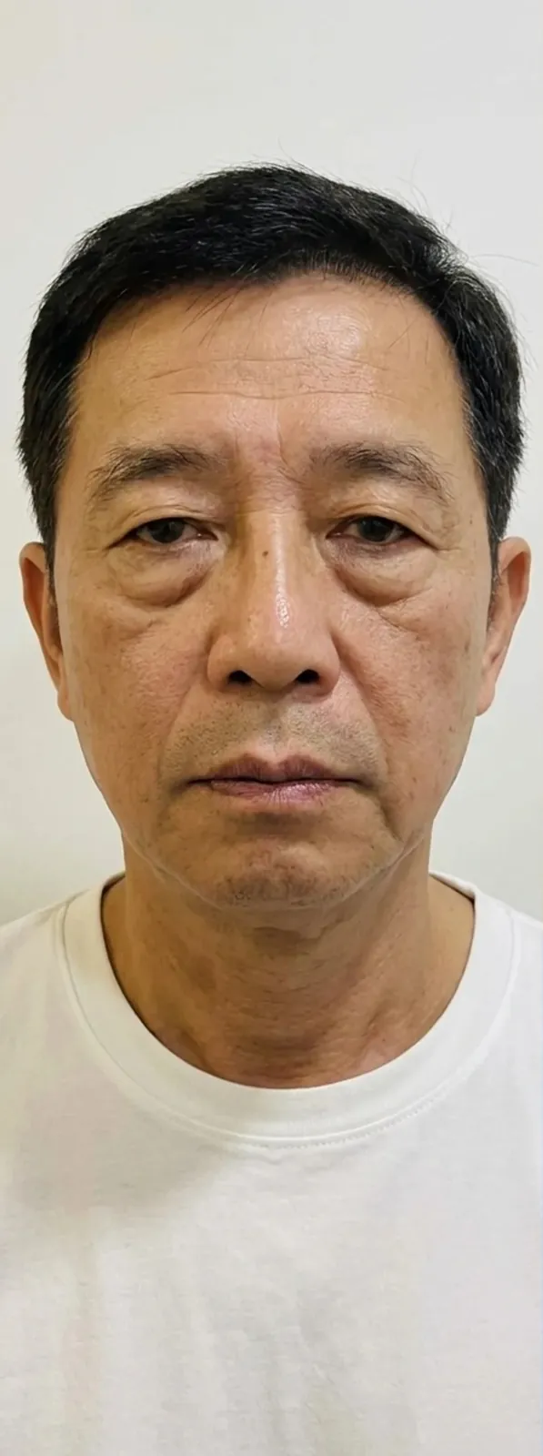 안면 리프팅 — 전