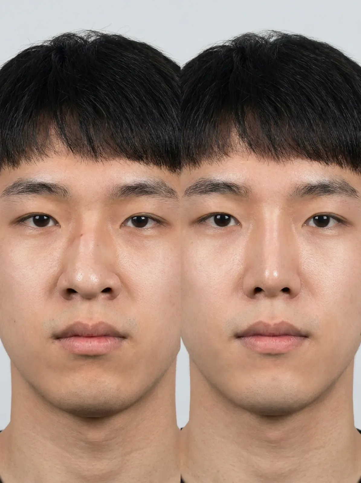 코 재수술 — 전 / 후