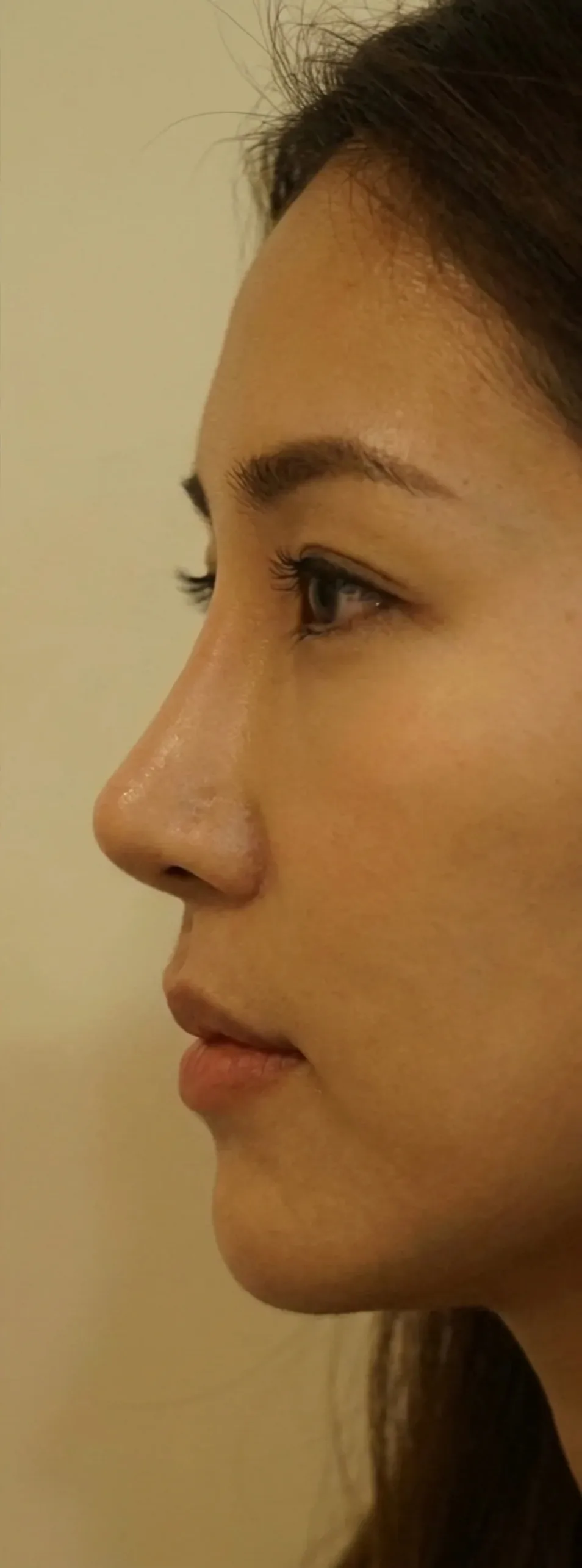 코성형 — 후