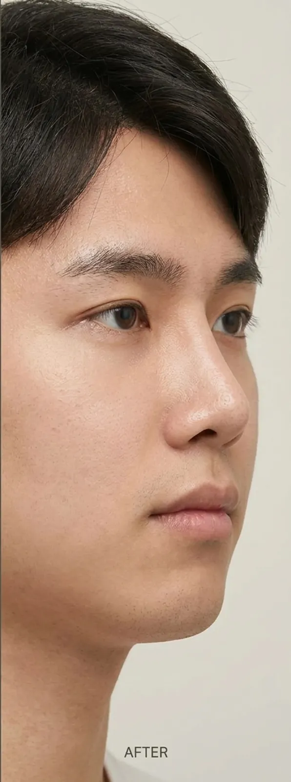 코끝 성형 — 후