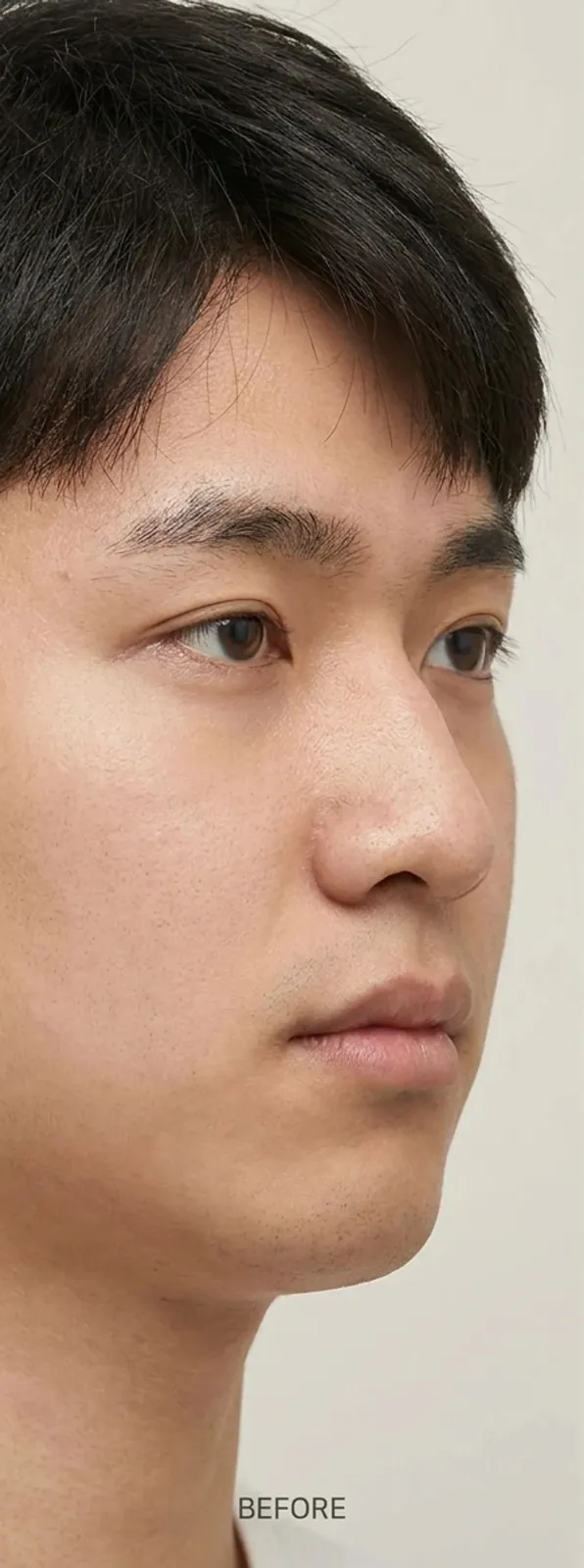 코끝 성형 — 전