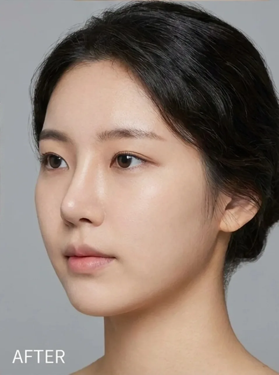 코끝 성형 — 후